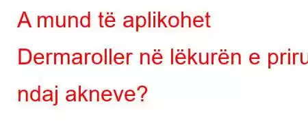 A mund të aplikohet Dermaroller në lëkurën e prirur ndaj akneve?