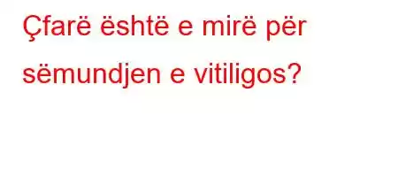 Çfarë është e mirë për sëmundjen e vitiligos?