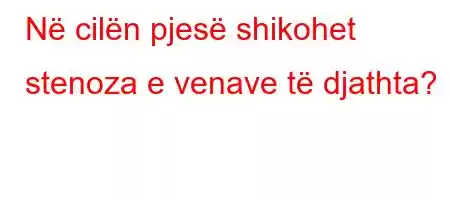 Në cilën pjesë shikohet stenoza e venave të djathta?